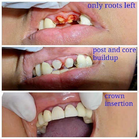 Dental Treatment Gallery 6